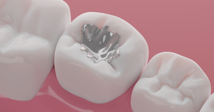 The Dental Filling Procedure: What To Expect From Start To Finish?