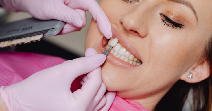 Can Porcelain Veneers Be Whitened?
