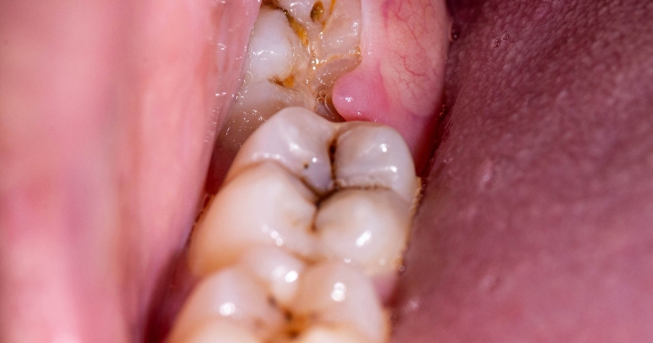 Signs You May Need Your Wisdom Teeth Removed